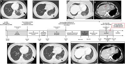 Successful sequential tyrosine kinase inhibitors to overcome a rare compound of EGFR exon 18–18 and EGFR amplification: A case report